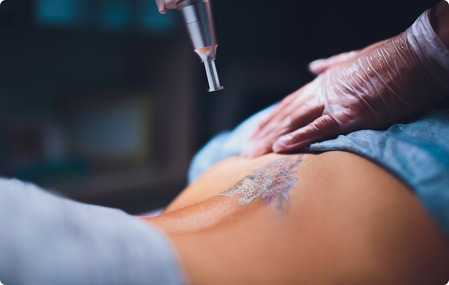 Laser Tattoo Removal