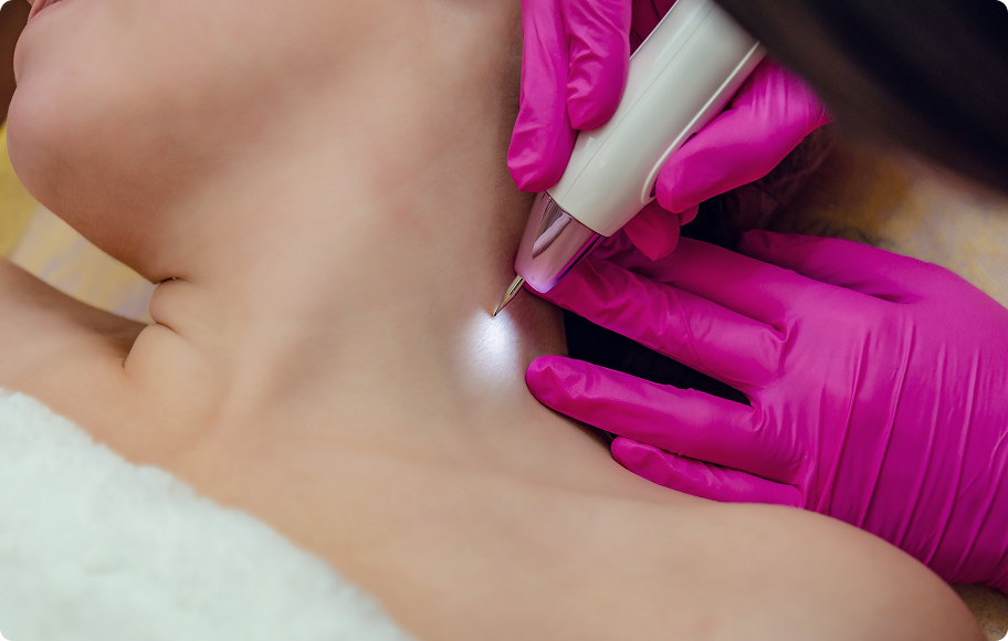 Skin Tag Removal